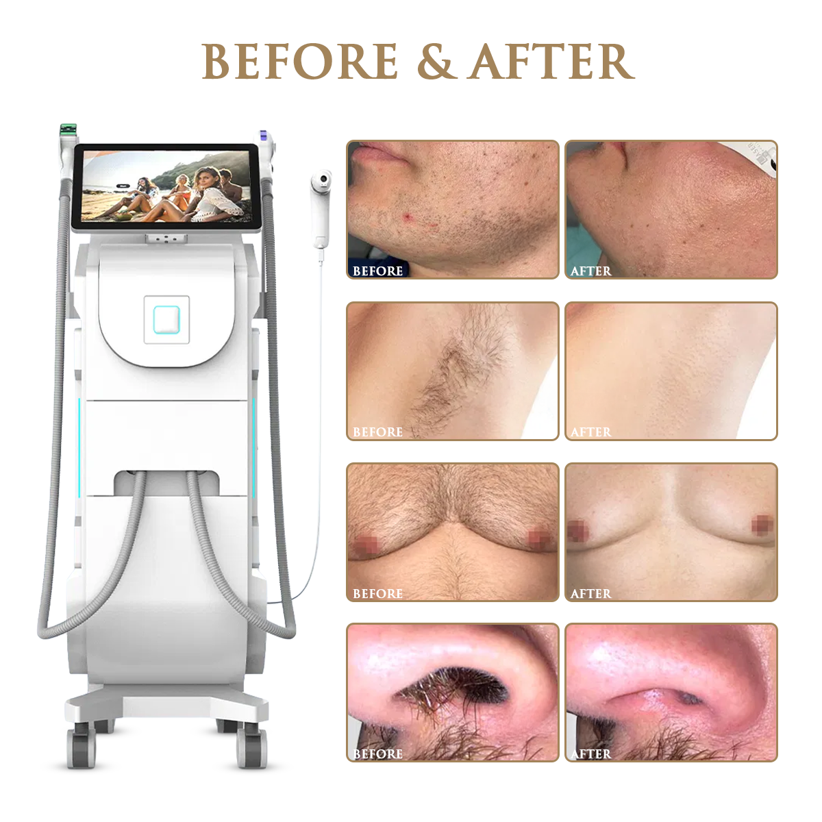 Skin Monarch Quantum Pro Diode & Picosecond Laser - BVShop